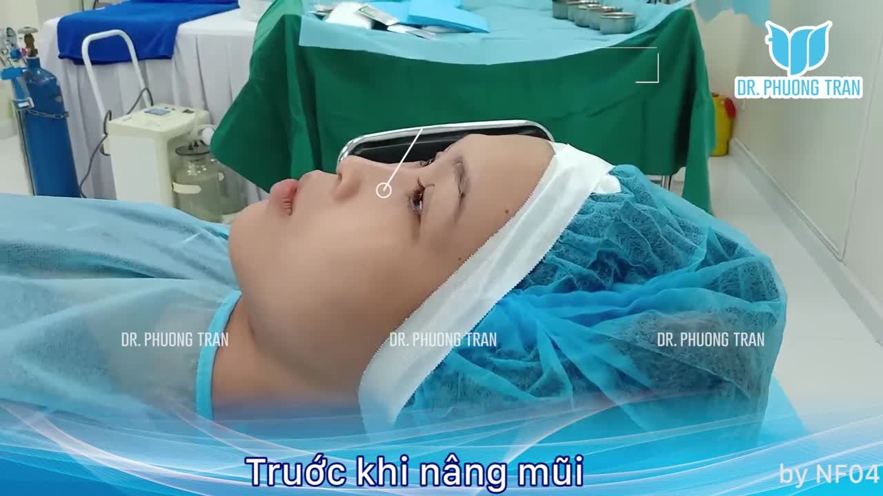 MŨI THẤP CÓ NÂNG CAO TÂY ĐƯỢC KHÔNG?