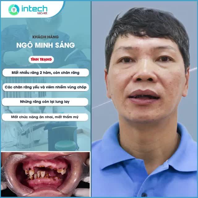 TRỒNG RĂNG ĐÓN TẾT ĂN NHAI TRỌN ĐỜI