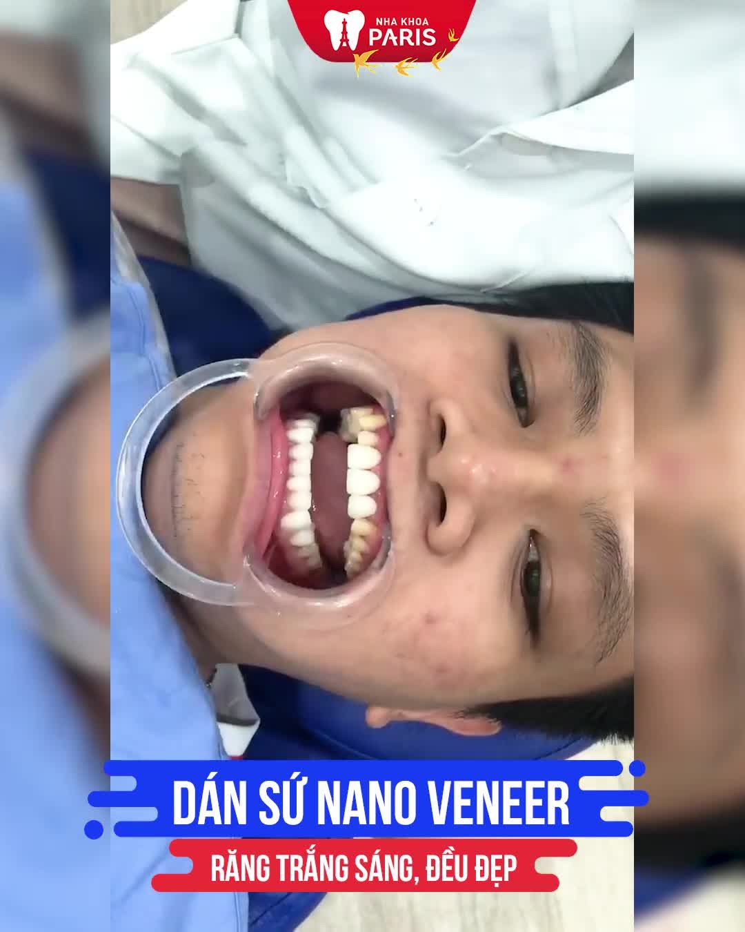 Hết Ố Vàng Mòn Men Răng Đẹp Hết Ý