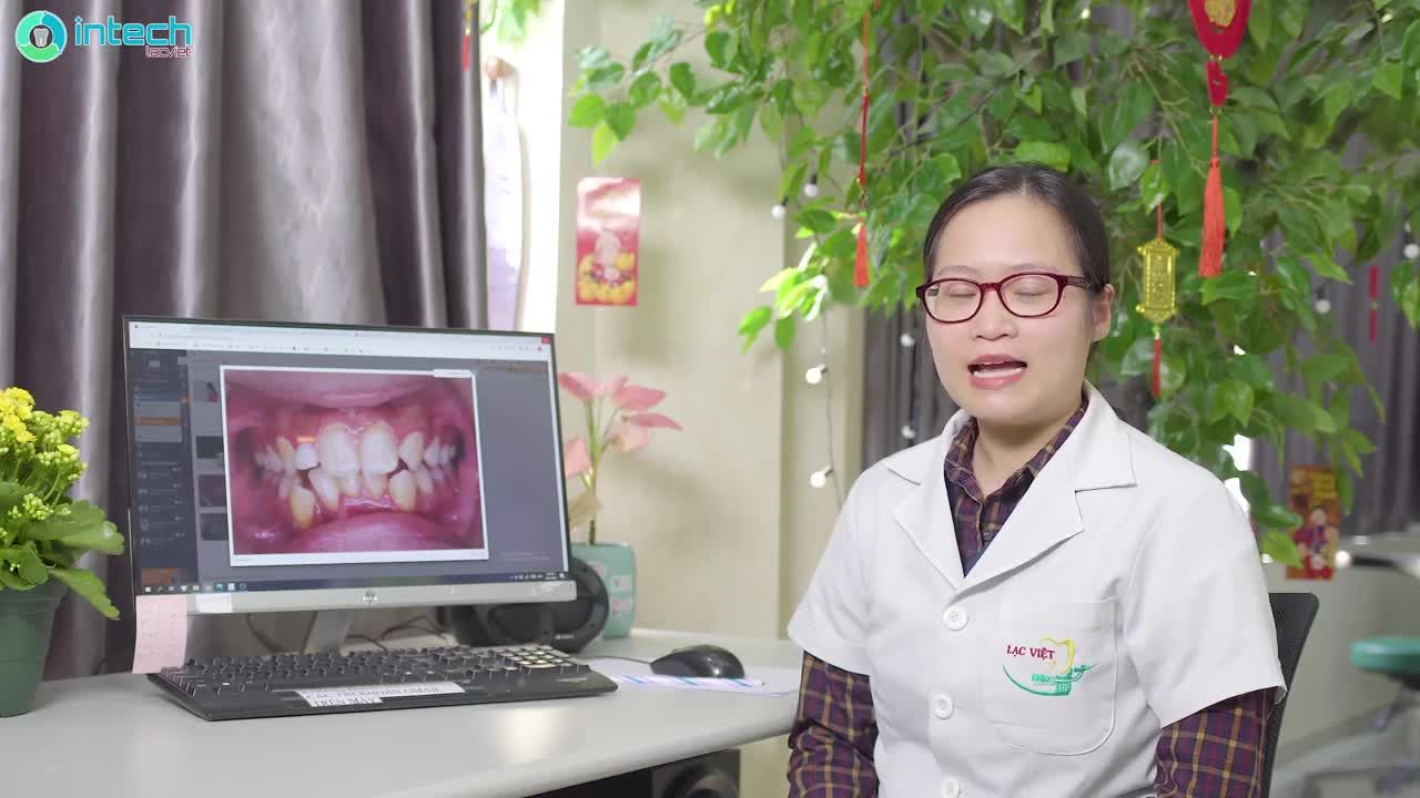 CA NIỀNG RĂNG KHẤP KHỂNH CHỈ ĐỊNH NHỔ 2 RĂNG CỬA HÀM DƯỚI THAY ĐỔI NGOẠN MỤC SAU 5 THÁNG