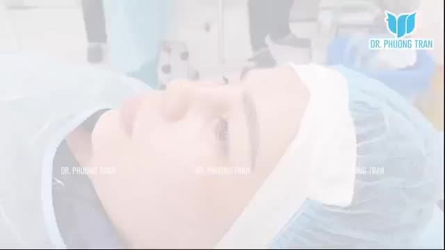 ĐẶT TRUNG BÌ MỠ KHẮC PHỤC MŨI BỊ VIÊM, DỊ ỨNG CHẤT LIỆU