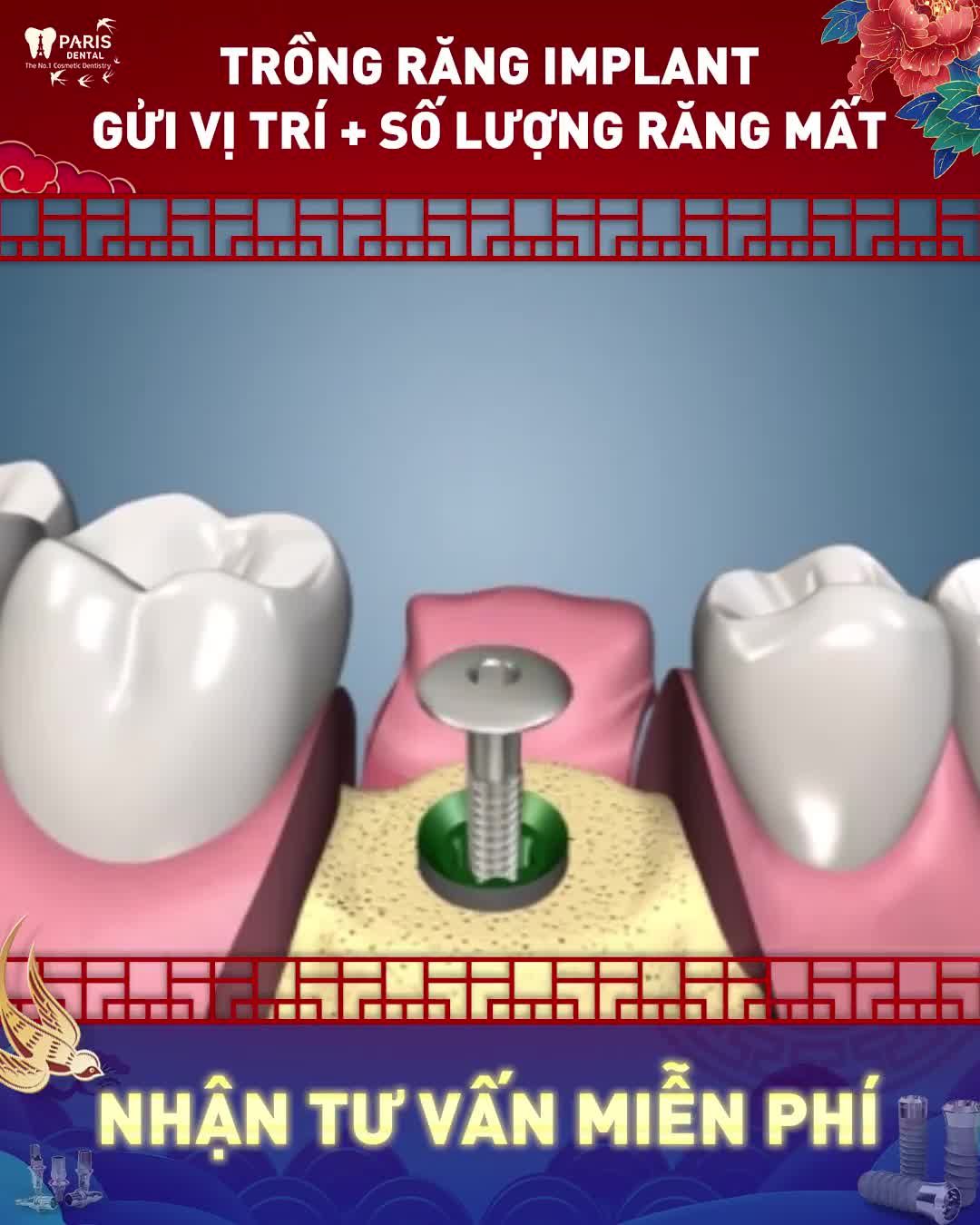 Cấy ghép implant Khôi phục răng mất toàn diện