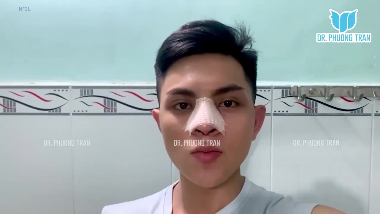 NGÀY ĐẦU TIÊN SAU NÂNG MŨI CẤU TRÚC KHÔNG ĐAU KHÔNG SƯNG KHÔNG BẦM. BẠN TIN KHÔNG?