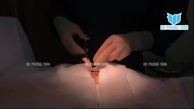 NÂNG MŨI CẤU TRÚC SỤN SƯỜN TOÀN PHẦN  AN TOÀN NHẤT, BỀN VỮNG NHẤT