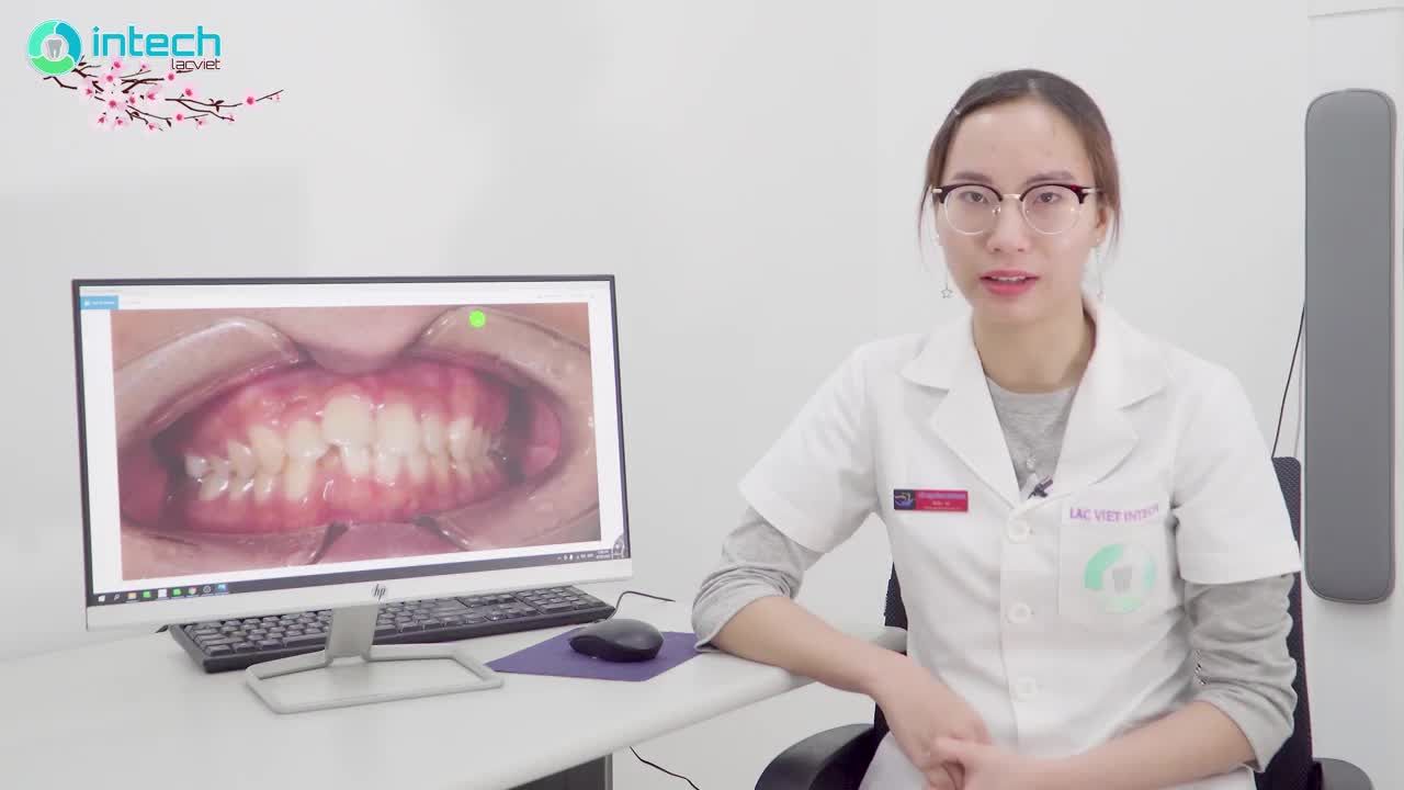 PHÂN TÍCH LÂM SÀNG CA NIỀNG RĂNG KHẤP KHỂNH VÀ CÓ HẸP HÀM Ở NGƯỜI LỚN- THÁO NIỀNG CHỈ SAU 11 THÁNG ĐIỀU TRỊ