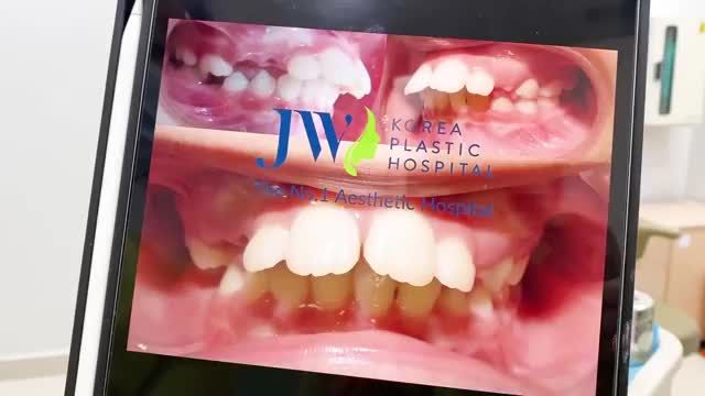 Tạm biệt răng lệch lạc NIỀNG RĂNG để có nụ cười tỏa sáng ngay!