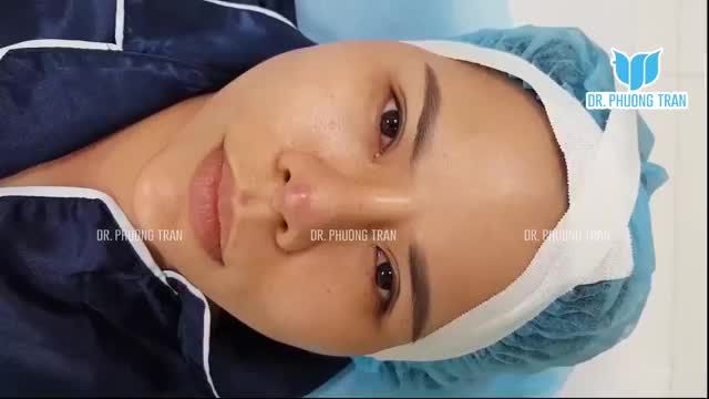 ĐẶT TRUNG BÌ MỠ KHẮC PHỤC MŨI BỊ VIÊM, ĐÀO THẢI CHẤT LIỆU