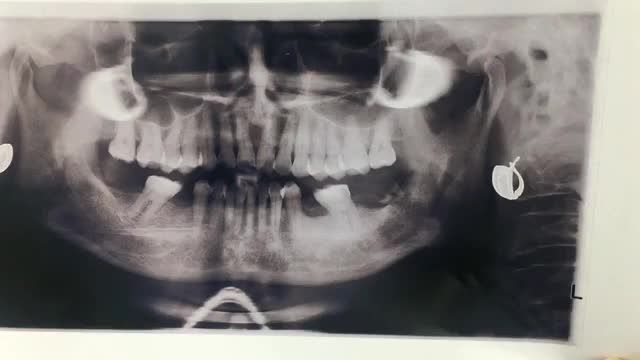 Cấy 2 chân răng nhân tạo implant tại Nha Khoa Thuỳ Anh.