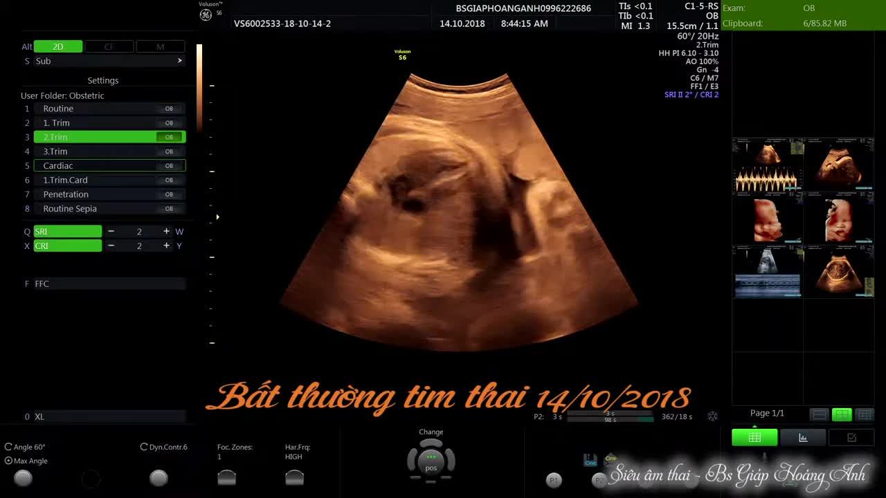 Bất thường tim thai 14/10/2018 - Siêu âm thai - Bác sĩ Giáp Hoàng Anh