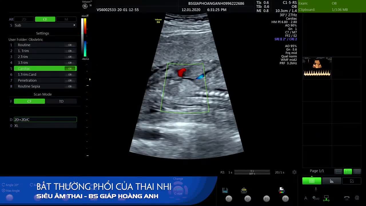 Bệnh nang tuyến phổi ở thai nhi - Hệ thống PK Siêu âm thai bs Giáp Hoàng Anh