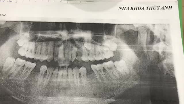 Ca cấy ghép chân răng nhân tạo implant.