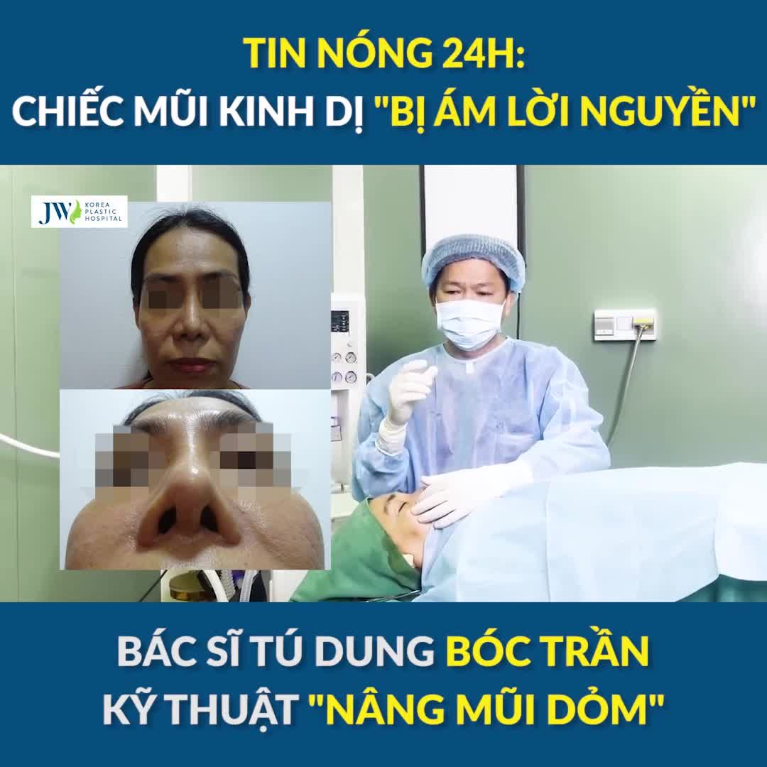 Cận cảnh Bác sĩ Tú Dung NÂNG MŨI SỤN SƯỜN sửa lại CHIẾC MŨI BIẾN DẠNG