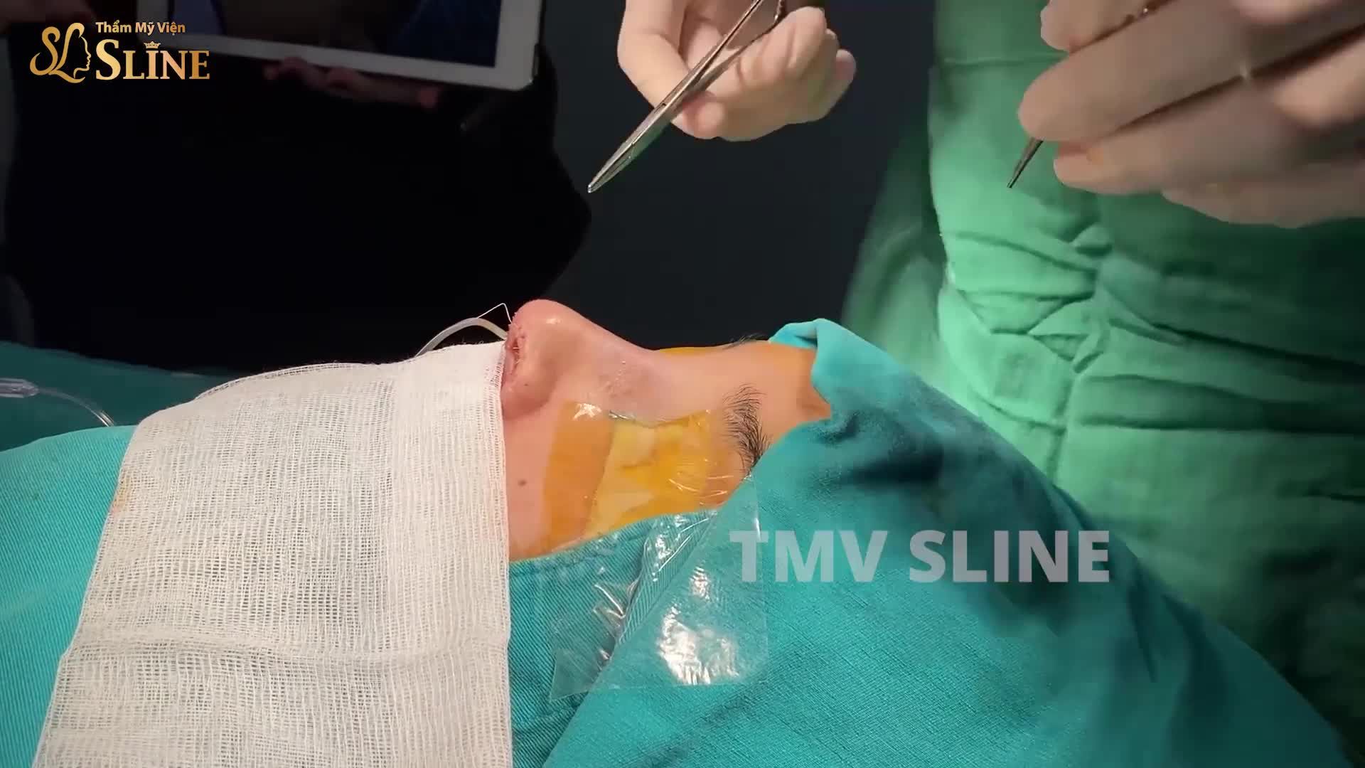 CẬN CẢNH DÁNG MŨI CẤU TRÚC SOFTXIL