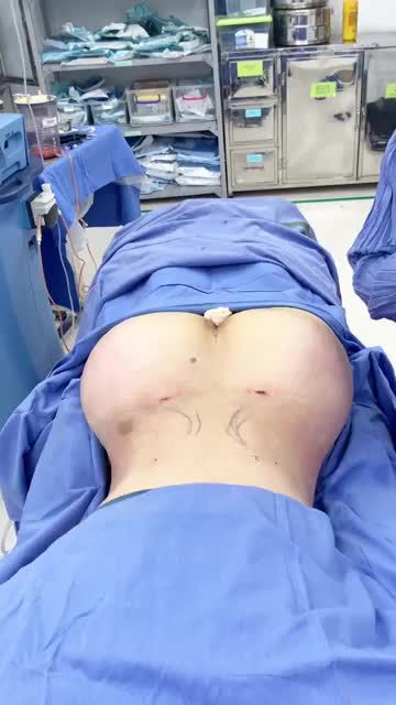 Cận cảnh kết quả Nâng vòng 3 đẹp mĩ mãn bằng mỡ tự thân