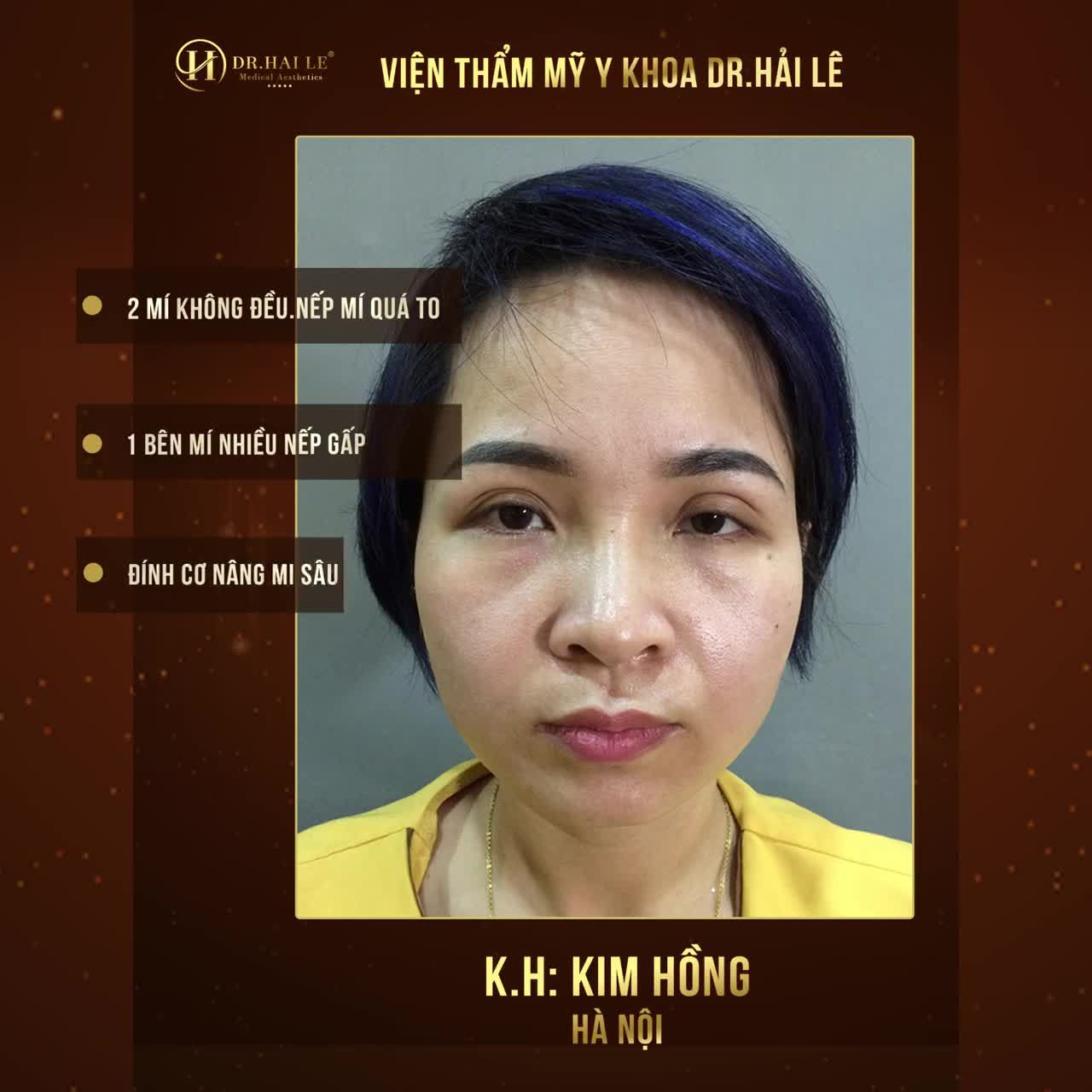 CẢNH BÁO “VỠ MỘNG” VỀ QUAN NIỆM CẮT MÍ QUÁ TO ĐỂ LÂU BỊ SỤP LẠI CỦA NHIỀU CHỊ EM!