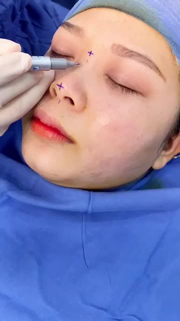 Cánh mũi to bè Sống mũi Tẹt Giải pháp nào tối ưu?  Xem ngay bác sĩ phân tích chi tiết giải pháp cho tình trạng này!