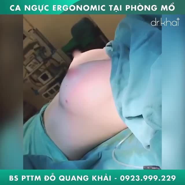 Case Ngực Ergonomix cuối ngày tại thẩm mỹ BS Đỗ Quang Khải