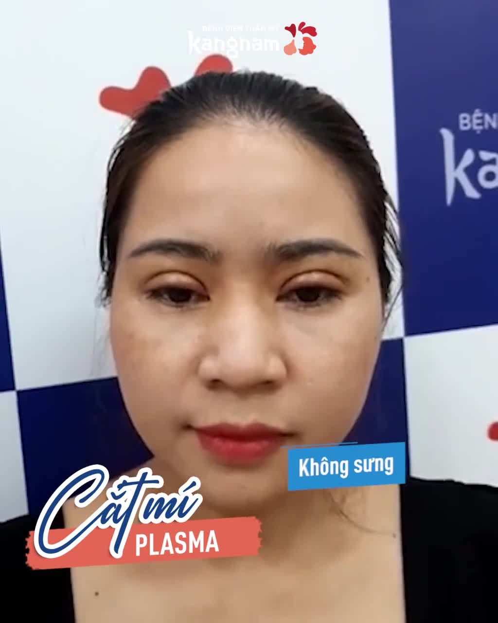 Cắt mí: Thao tác nhỏ Thay đổi lớn