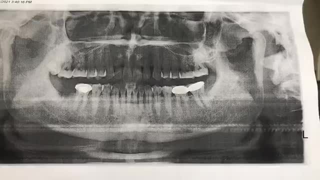 Cấy chân răng nhận tạo implant.