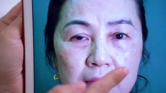 Chào buổi sáng với ca Cắt mí khắc phục 1 bên nhược cơ, 1 bên cường cơ và cùng lắng nghe chia sẻ của chị khách hàng sau khi cắt mí tại Dr.Hải Lê như thế nào nhé!