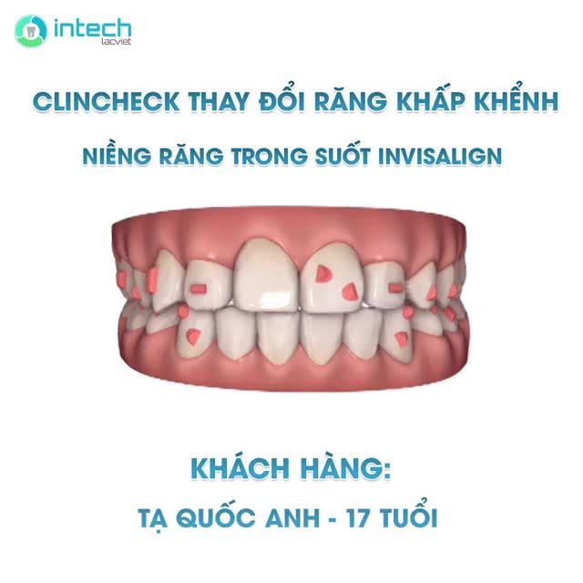 CLINCHECK NIỀNG RĂNG INVISALIGN CỦA KHÁCH HÀNG TẠ QUỐC ANH