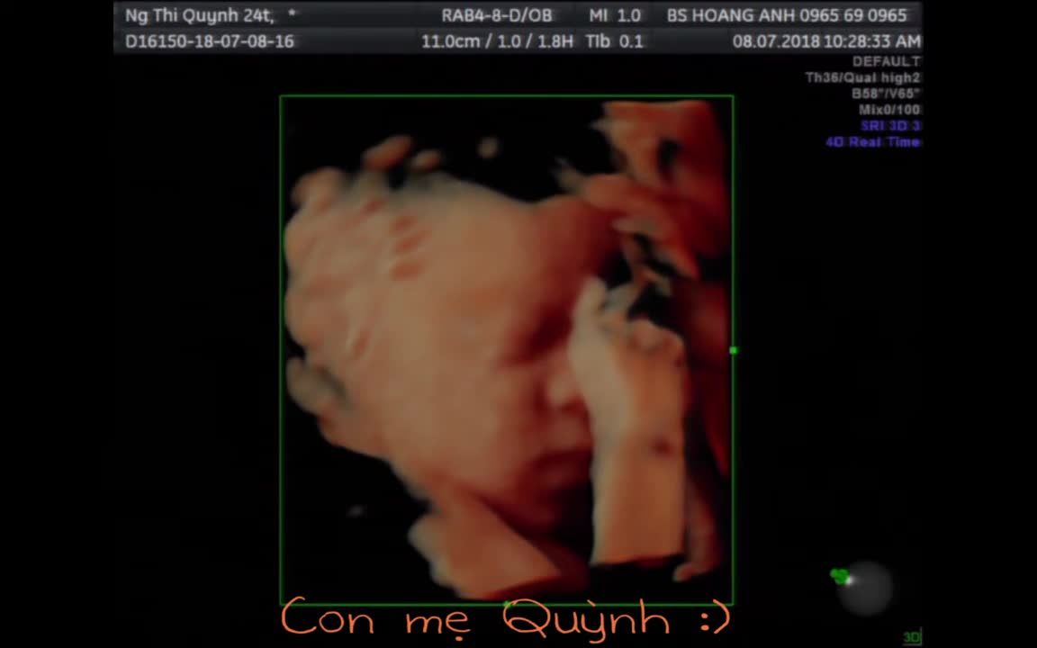 Con của mẹ Nguyễn Thị Quỳnh 24T 8/7/2018 - Siêu âm thai - Bs Giáp Hoàng Anh