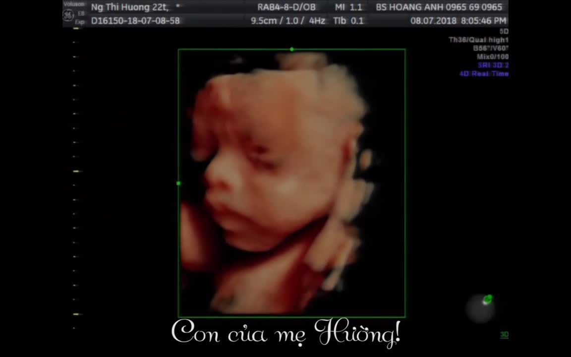 Con mẹ Nguyễn Thị Hường 22T 7/8/2018 Siêu âm thai Bs Giáp Hoàng Anh