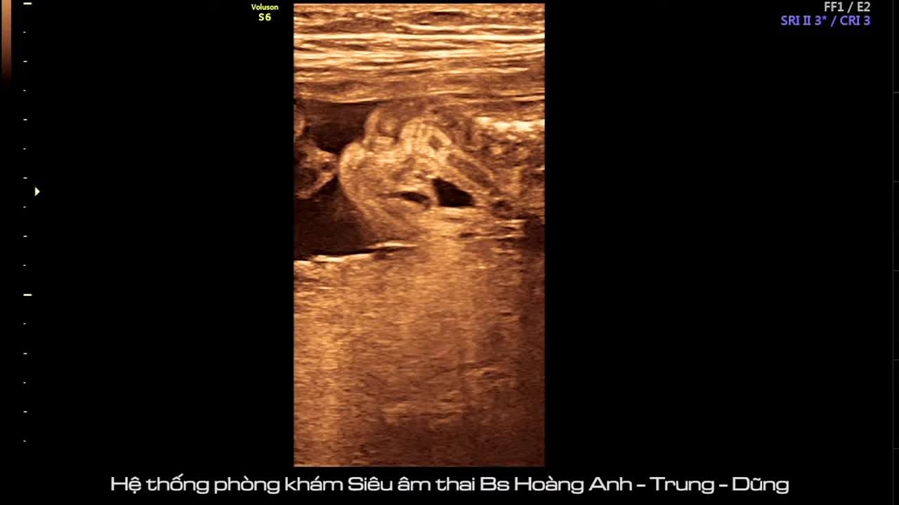 Đại tràng của thai nhi - 18 tuần. Hệ thống Phòng khám siêu âm sàng lọc dị tật chuyên sâu Hoàng Anh