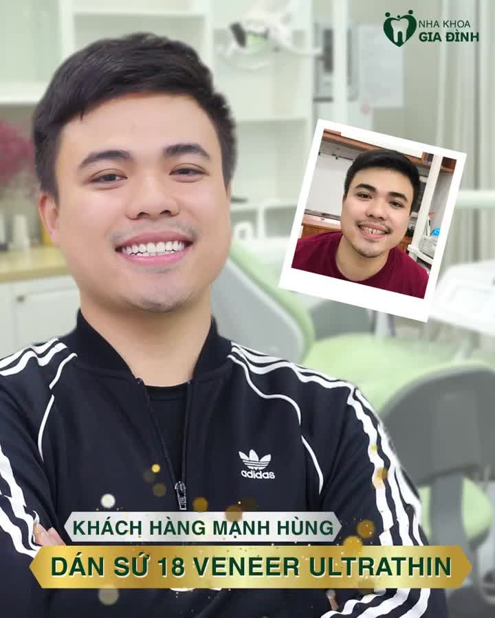 DÁN SỨ VENEER CHO KHÁCH HÀNG MẠNH HÙNG