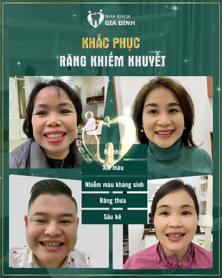 ĐẸP KHOE, XẤU CHE NHƯNG RĂNG KHIẾM KHUYẾT THÌ CHE BẰNG CÁCH NÀO???