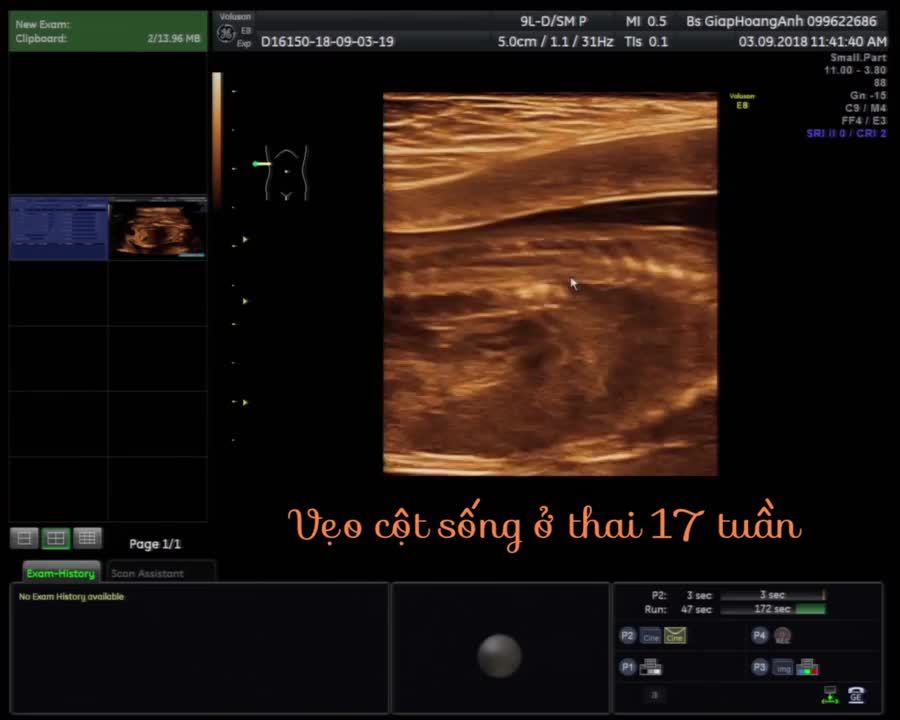 Dị tật cột sống cong vẹo thai 17 tuần phát hiện tại Siêu âm thai - Bác sĩ Giáp Hoàng Anh