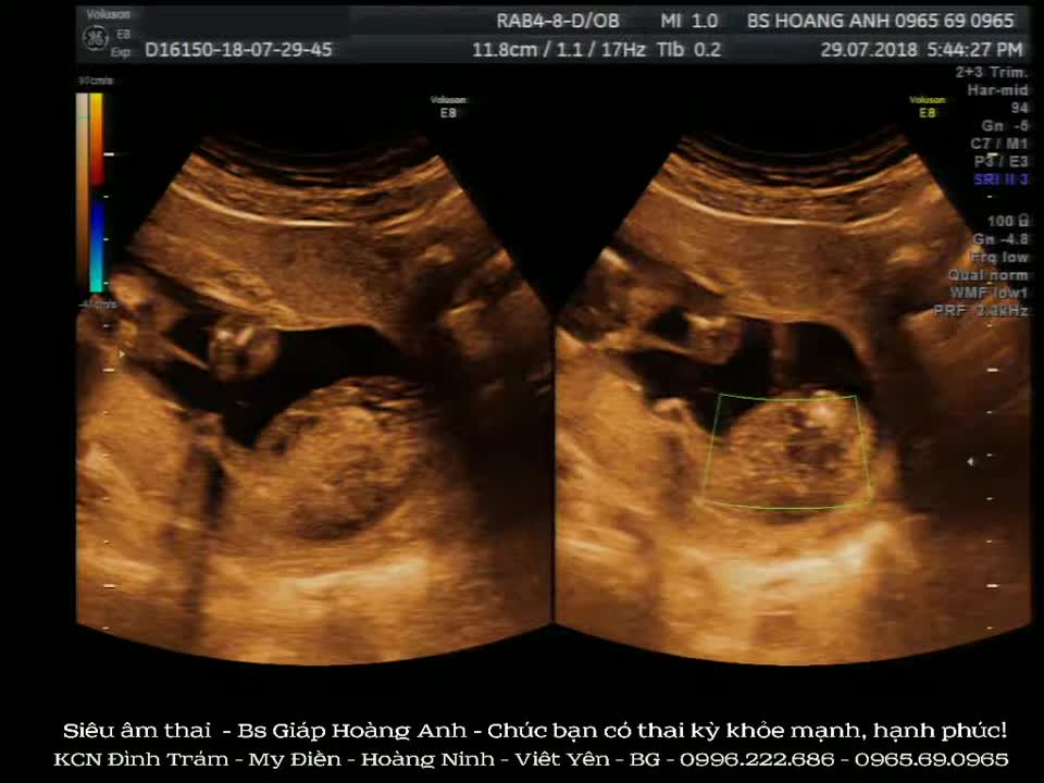 Dị tật song thai, một thai không tim không đầu - siêu âm thai - Bs Giáp Hoàng Anh