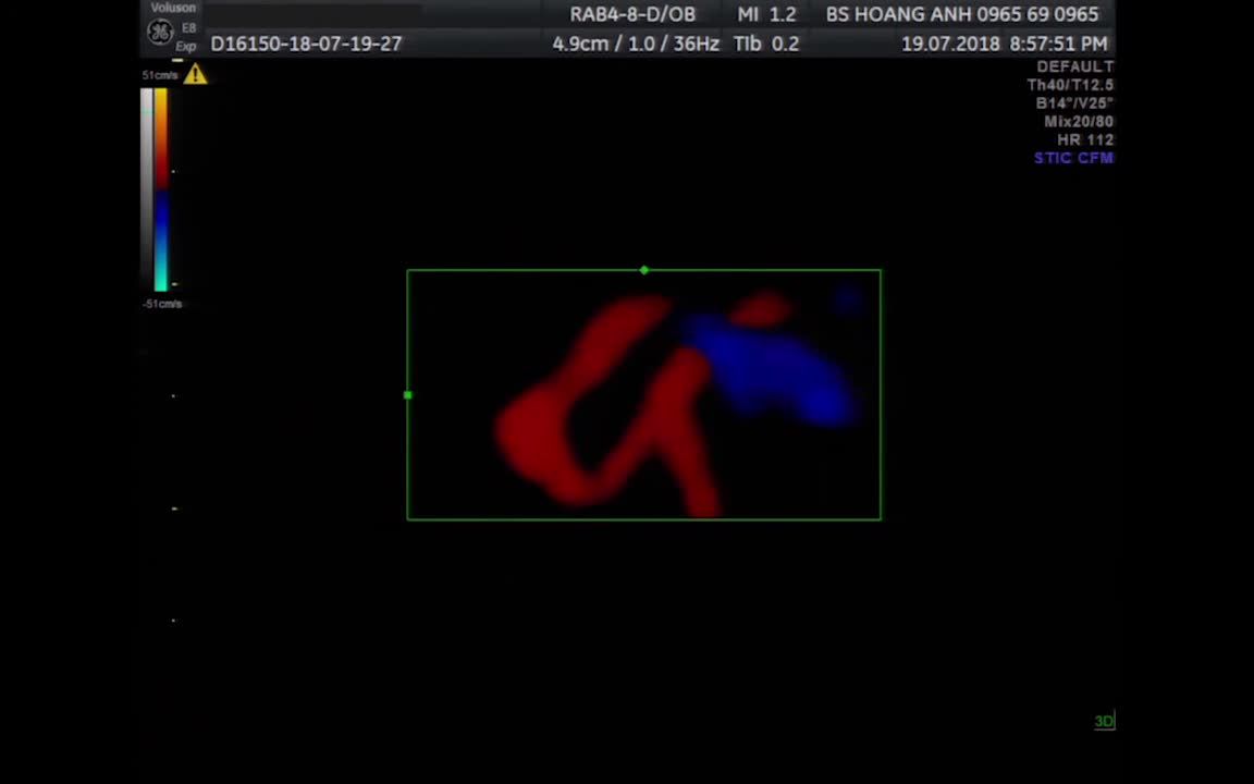 Dị tật tim thai 18 tuần - Siêu âm thai - Bs Giáp Hoàng Anh