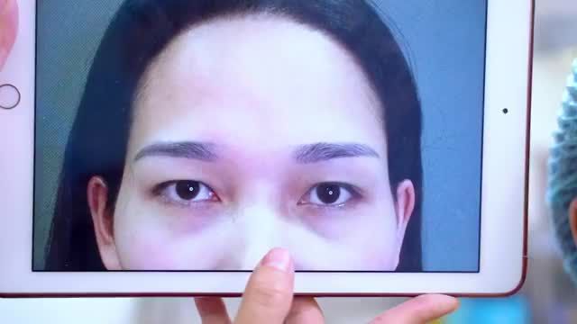 Độn vùng trên gò má giải phóng nhân tướng học gò má cao, thái dương hóp cho chị em phụ nữ