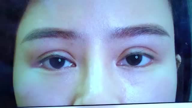 Em gái quyết tâm sửa lại mí mắt để tự tin giao tiếp với mọi người sau kho lỡ dại 1 lần cắt mí tại spa
