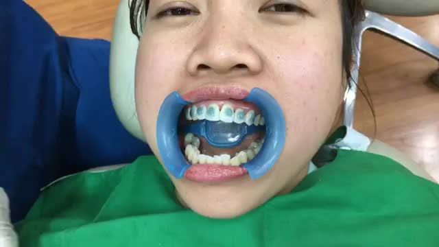 Gắn mắc cài điều trị hô cho bạn Anh khách hàng tại Nha Khoa Thuỳ Anh.