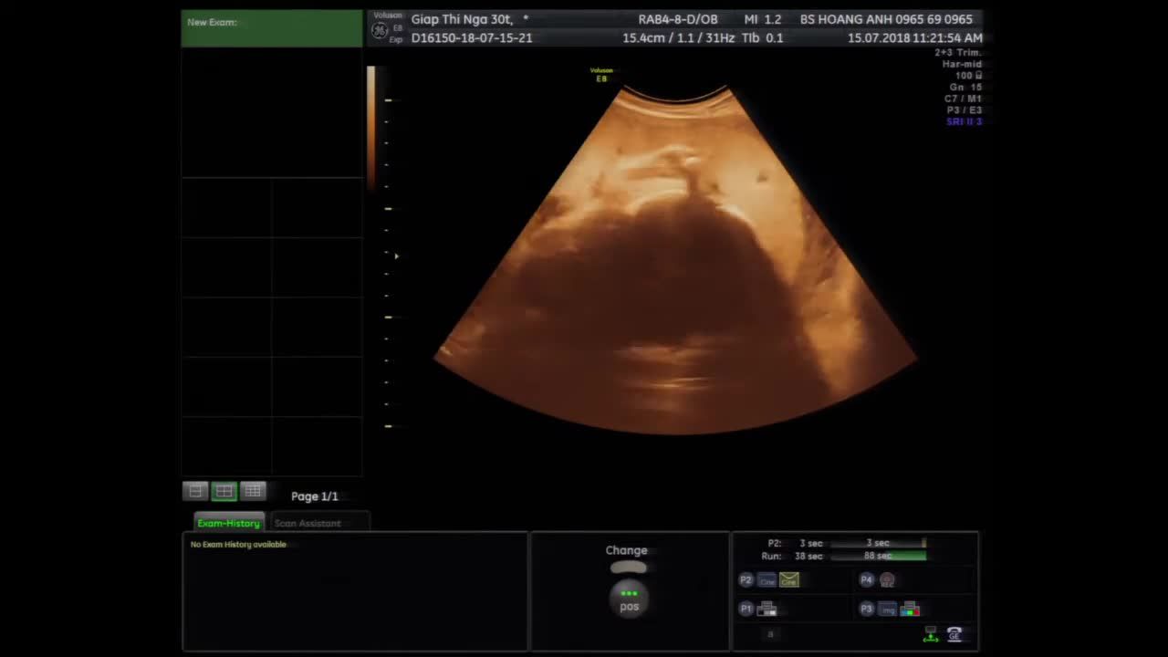 Giãn não thất bên ở thai nhi - Siêu âm thai - Bs Giáp Hoàng Anh