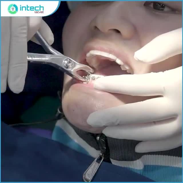 HÔ BIẾN HÀM RĂNG MÓM SAU 21 THÁNG BẰNG PHƯƠNG PHÁP NIỀNG RĂNG MẮC CÀI KIM LOẠI
