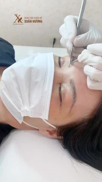 KẾT QUẢ KHÁCH HÀNG NGAY SAU KHI THỰC HIỆN ĐỒNG THỜI 2 DỊCH VỤ: NÂNG CUNG MÀY + CẮT MÍ DƯỚI TẠI BVTM XUÂN HƯƠNG