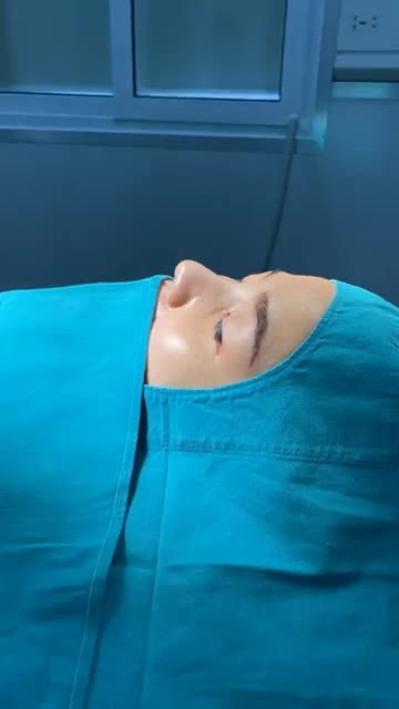 KẾT QUẢ NÂNG MŨI SLINE THỰC HIỆN BỞI EKIP SLINE Dáng mũi đẹp mọi góc nhìn sau 30P