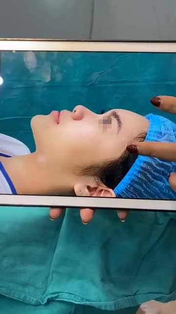 KẾT QUẢ SỬA MŨI CHO BẠN GÁI ĐÃ NÂNG CHỈ CƠ SỞ KHÁC