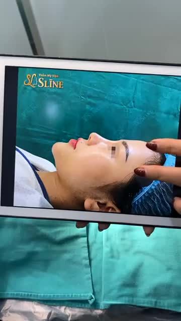 KẾT QUẢ SỬA MŨI LỖI CHO BẠN GÁI 22T
