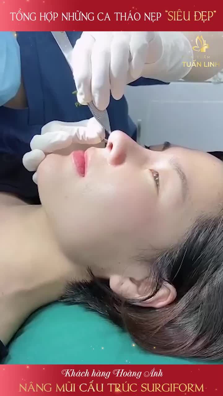 MŨI ĐẸP NGAY SAU THÁO NẸP LÀ CÓ THẬT!