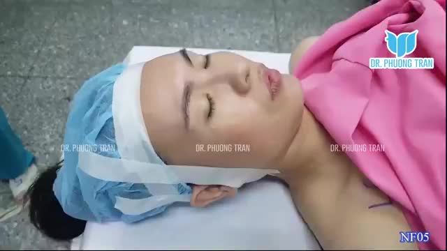 MŨI GỒ, ĐẦU MŨI HƠI CỤP SẼ THAY ĐỔI THẾ NÀO SAU NÂNG MŨI SỤN SƯỜN