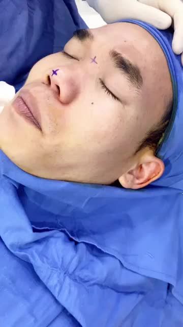 Mũi thấp tẹt Hếch gây mất thẩm mỹ gương mặt?