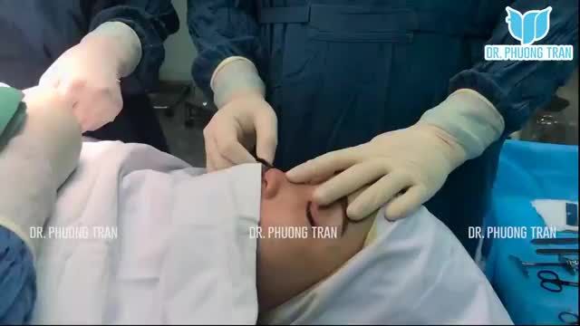 NÂNG MŨI CẤU TRÚC SỤN SƯỜN GIẢI PHÁP AN TOÀN, BỀN VỮNG NHẤT CHO CHIẾC MŨI CỦA BẠN