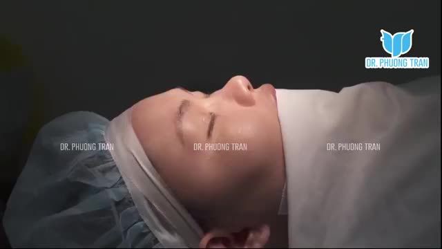 NÂNG MŨI CẤU TRÚC SỤN SƯỜN TOÀN PHẦN + CẤY MỠ MI DƯỚI, CẤY MỠ MÁ