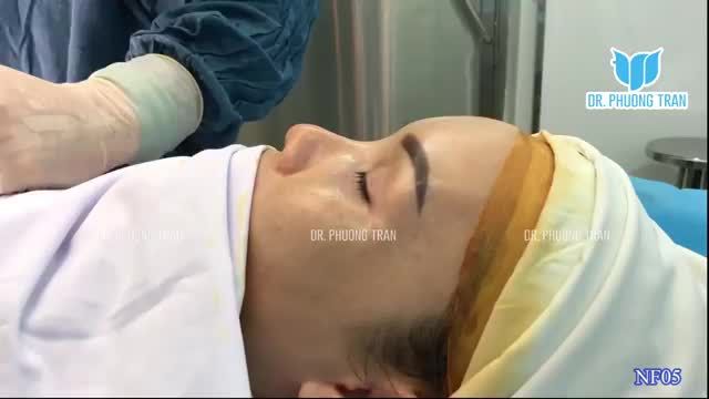 NÂNG MŨI CẤU TRÚC SỤN SƯỜN TOÀN PHẦN + GHÉP SỤN RÃNH MŨI MÁ