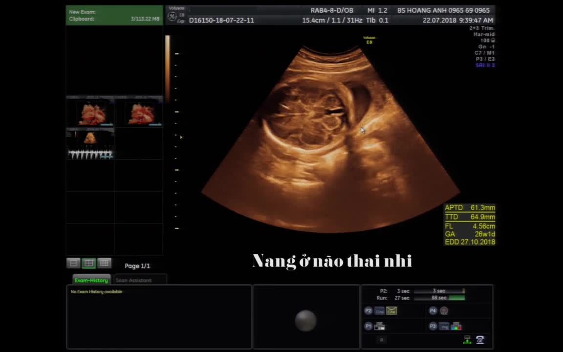 Nang ở não thai nhi - Siêu âm thai - Bs Giáp Hoàng Anh