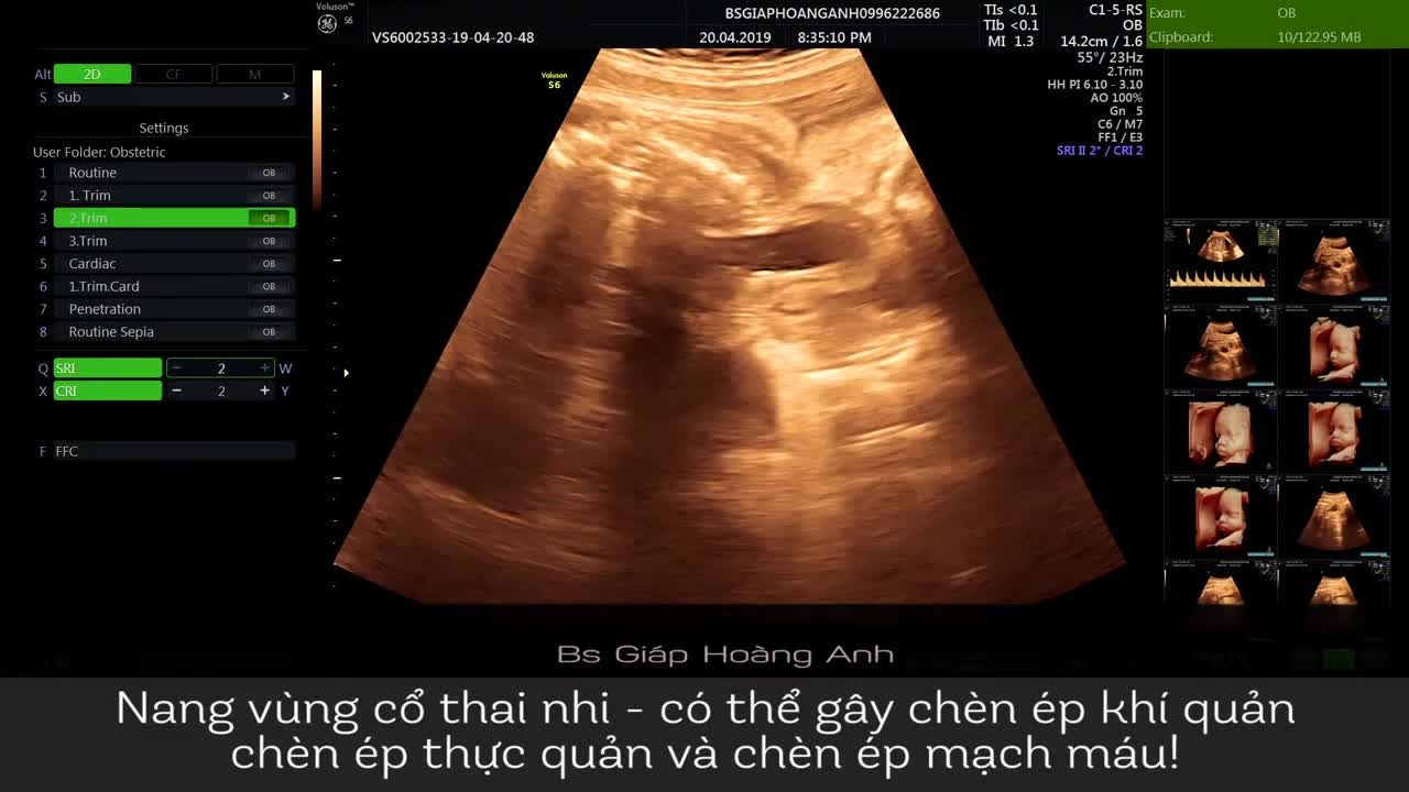 Nang vùng cổ ở thai nhi - Do bác sĩ trong hệ thống PK Siêu âm thai Giáp Hoàng Anh phát hiện